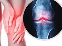关节炎？怎样保护膝关节